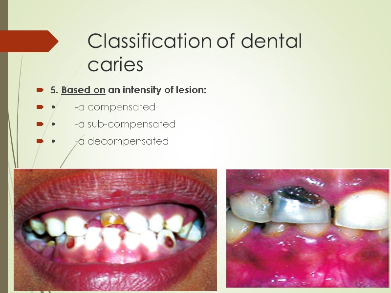 Classification of dental caries 5. Based on an intensity of lesion:  • -a